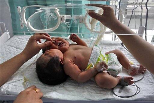 Medical workers attend to conjoined twin babies with a single body and two heads born on May 5 in a hospital in Suining city in southwestern China.