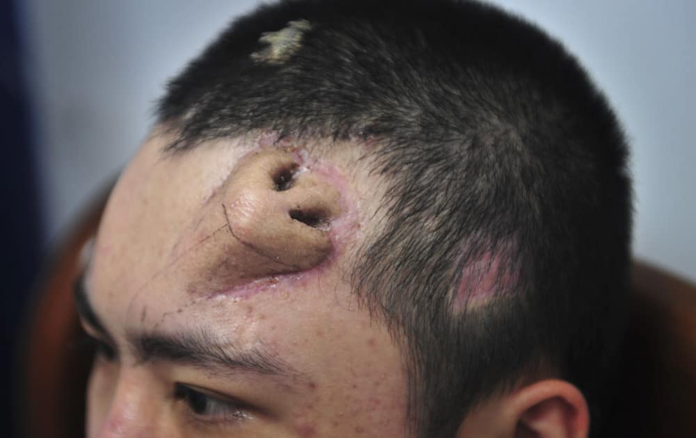 A 22-year-old patient, with a surgical made extra nose out of his rib cartilage and implanted under the skin of his forehead, rests at Fujian Medical University Union Hospital, in Fuzhou city, in southeast China`s Fujian province.