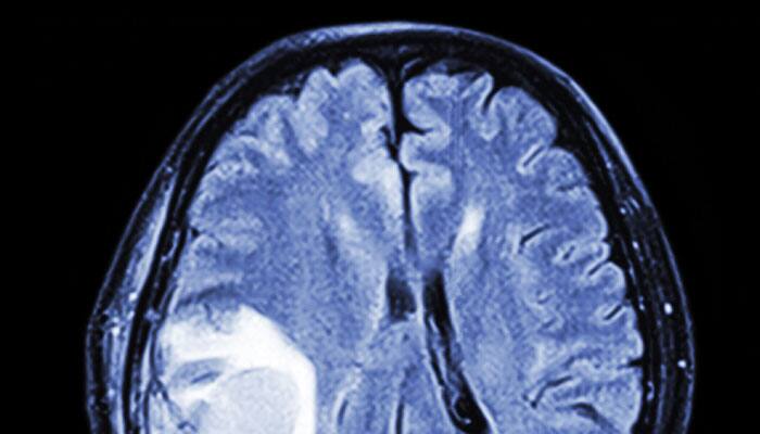 Standard guidelines suggested to treat brain tumour in ...