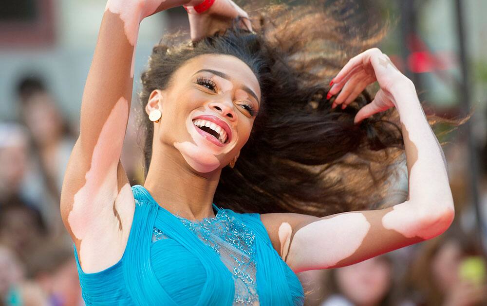 Winnie Harlow poses on the red carpet during the 2015 Much Music Video Awards in Toronto.