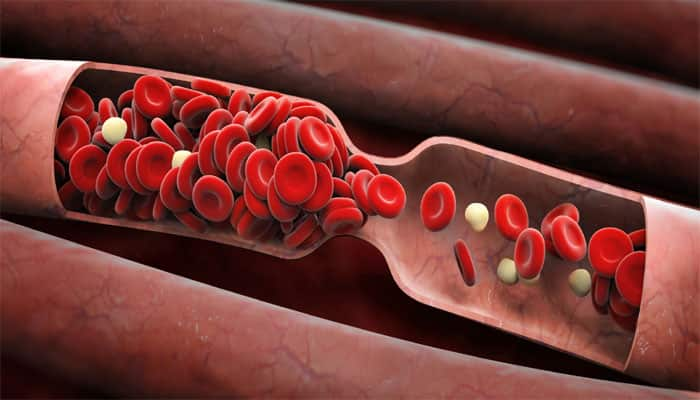 Single whole-body scan can detect blood clots | Health News | Zee News