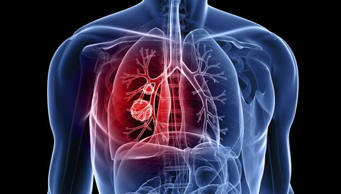 New method for targeted drug delivery to lung | Health News | Zee News