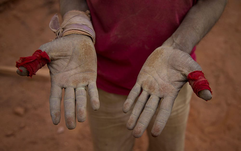 An Indian laborer shows his hands wounded by working at a brick kiln in Budgham area, southwest of Srinagar, India.