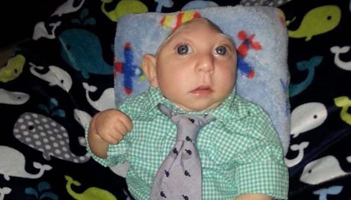 baby born without brain and skull