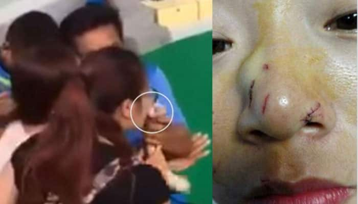 Woman brutally bitten on nose after she tries to kiss a python - Watch this  viral video, World News