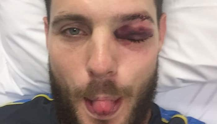 PHOTO: OUCH! Mitchell McClenaghan fractures eye socket as ball smashes through grille 