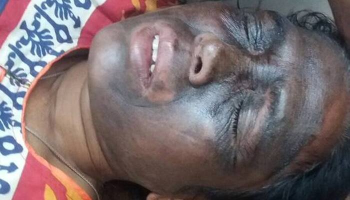 Attack on AAP leader Soni Sori: Police says it wasn&#039;t acid