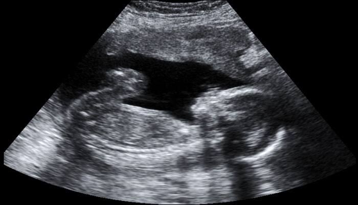 Two-month-old babies in the womb drink their own pee