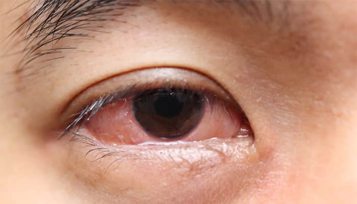 Know the common causes of red or bloodshot eyes! | Health News | Zee News