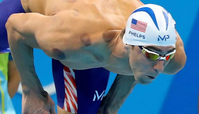 EXPLAINED: Why Olympics legend Michael Phelps is covered in red dots - WATCH