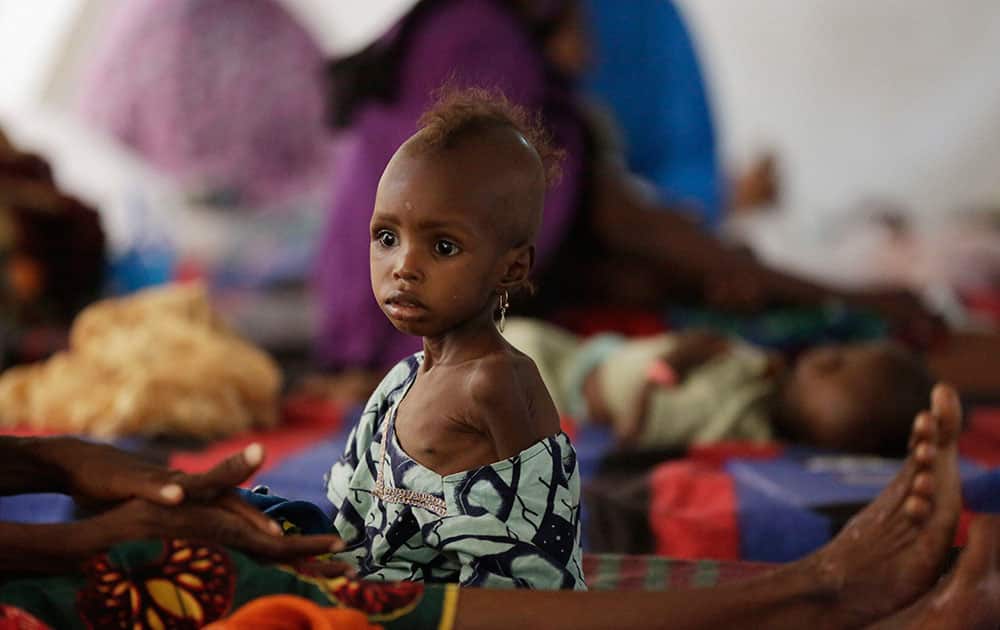 A malnourished child receives health care at a feeding centre run by Doctors Without Borders A malnourished child receives health care at a feeding centre run by Doctors Without Borders
