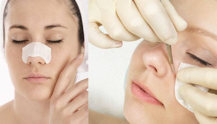 Are blackheads giving you nightmares? Relax, and watch this video