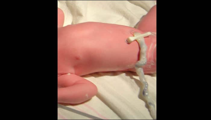 Delayed procedure of cutting the umbilical cord after delivery gives your baby numerous health benefits, say physicians!