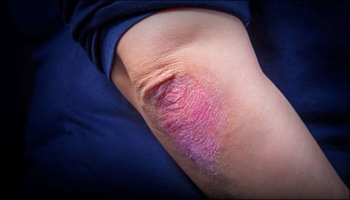 Stigma, depression and anxiety may cause psoriasis to recur in patients