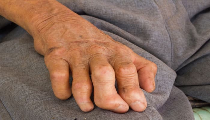 Govt reports India having the maximum cases of leprosy in the world at 60 percent