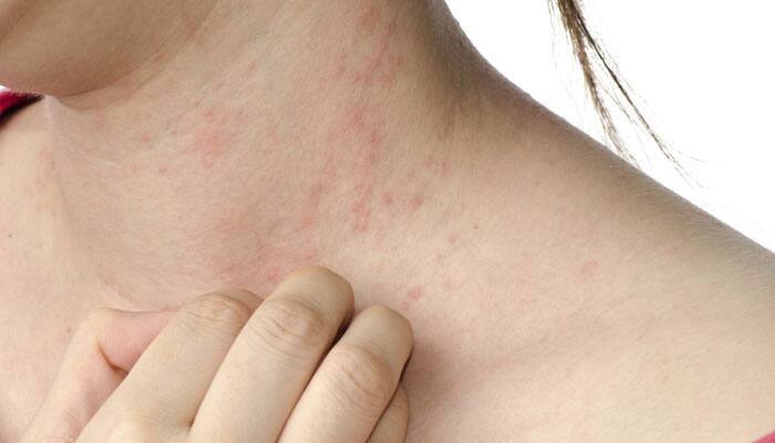  Eczema has another cause – lack of protein skin barrier responsible to triggering condition