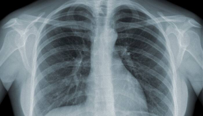 India&#039;s tuberculosis challenge: Drug-resistant TB could make up 1 in 10 cases of disease by 2040