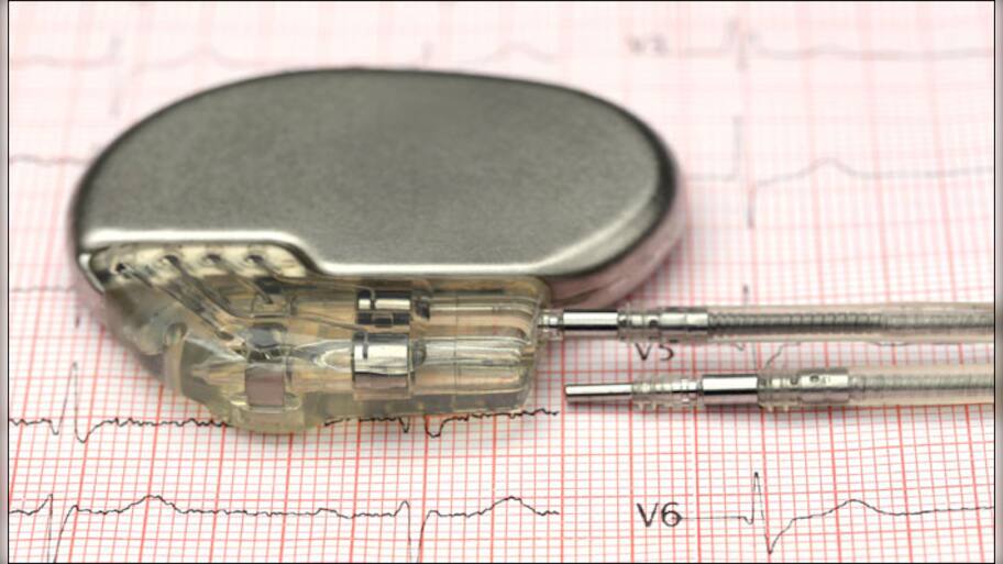 Wireless, battery-less pacemaker developed | Health News | Zee News