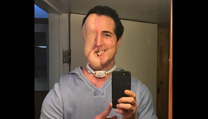 Tumour has left this 38-year-old man half-faced!