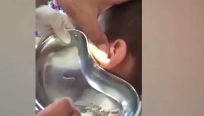 Doctor removes dozens of squirming live maggots from boy&#039;s ear – Watch the video!