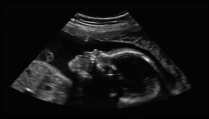 Doctors in India witness a rare case of &#039;fetus-in-fetu&#039; after baby is born &#039;pregnant&#039; with twin brother!