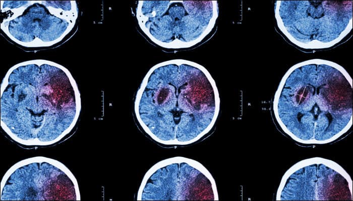 Excessive brain cell growth post injury may cause seizures