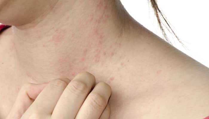 Hard water can damage skin, cause eczema: Study