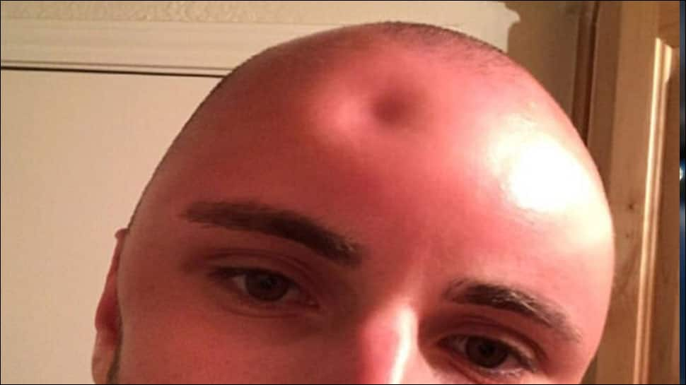 Texas man left with golf ball-sized dent in forehead as a result of sunburn - See pics