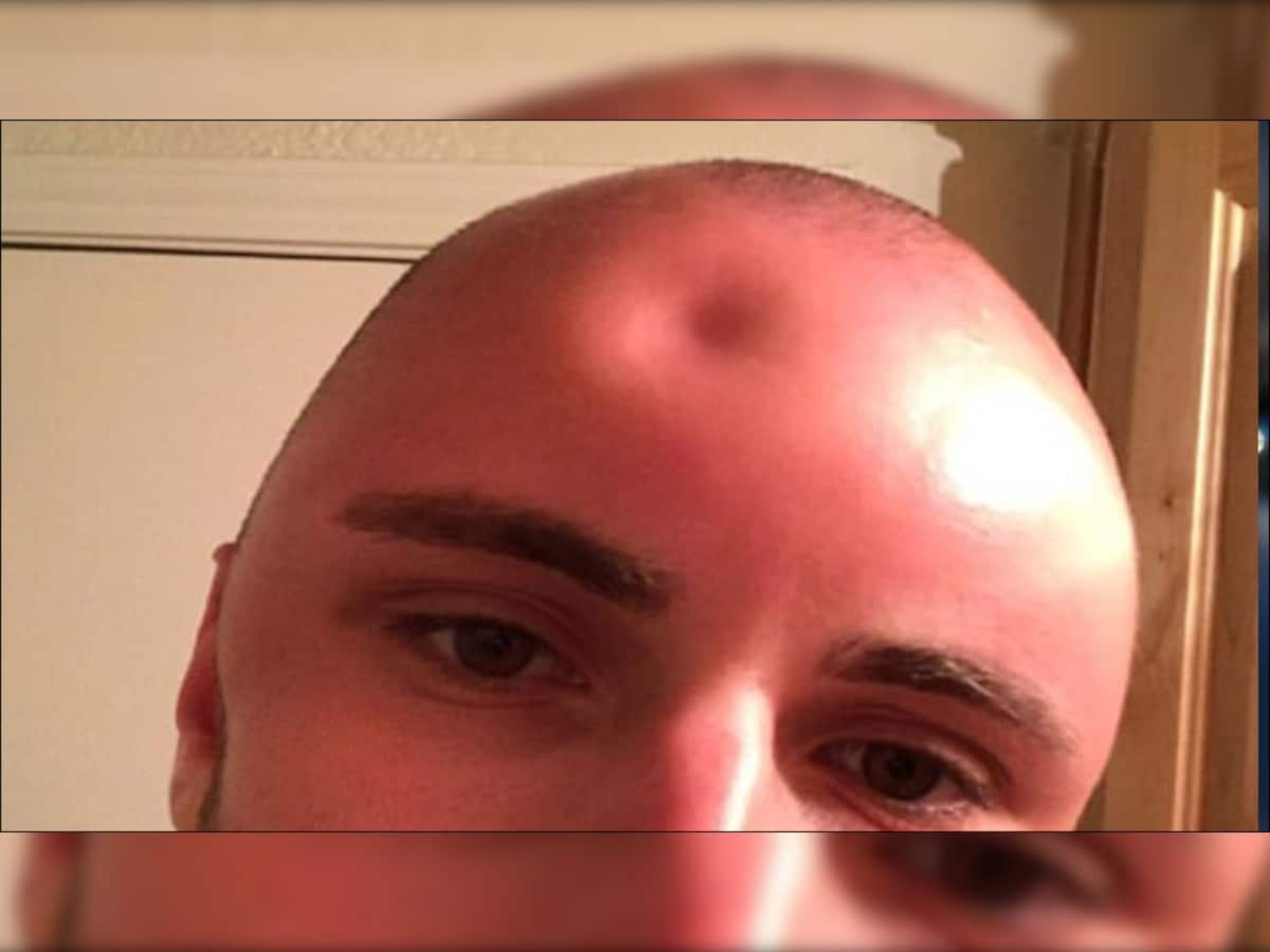 Texas man left with golf ballsized dent in forehead as a result of