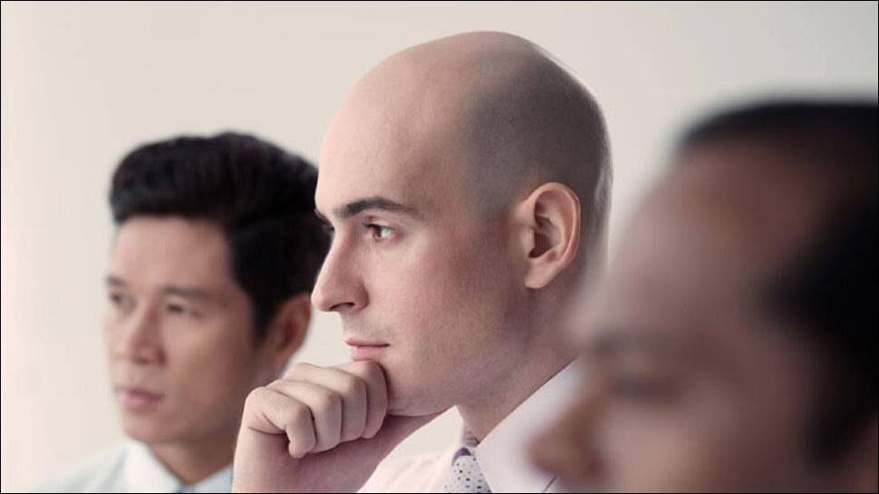 Study associates premature baldness with increased heart disease risk in men