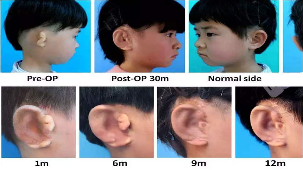 Breakthrough! Five children receive new ears grown from their own cells