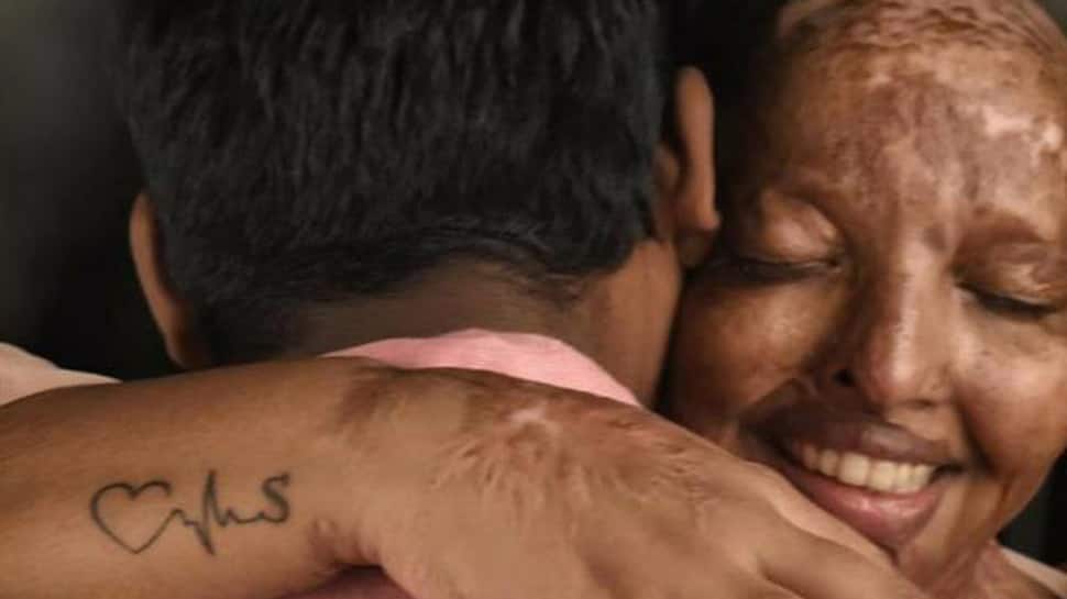 Love triumphs as acid attack victim gets engaged on Valentine&#039;s Day