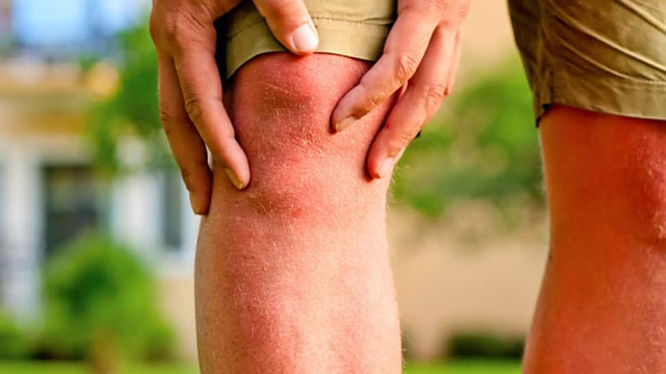 Lap-band surgery may lower chronic knee pain