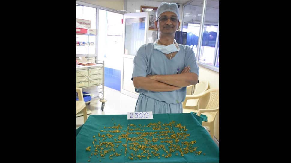 Mumbai doctors remove 2,350 stones from 50-year-old woman&#039;s gallbladder