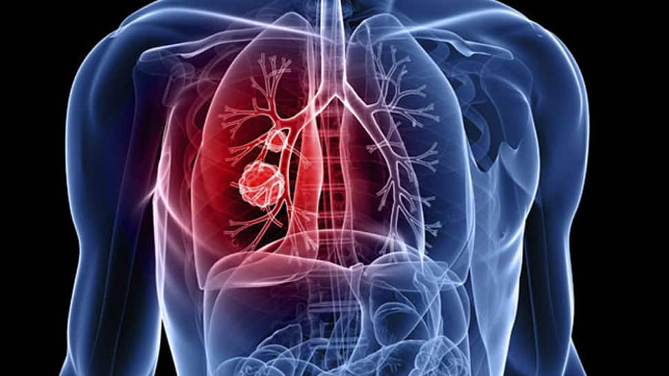 New immunotherapy for lung cancer may be effective, safe: Lancet