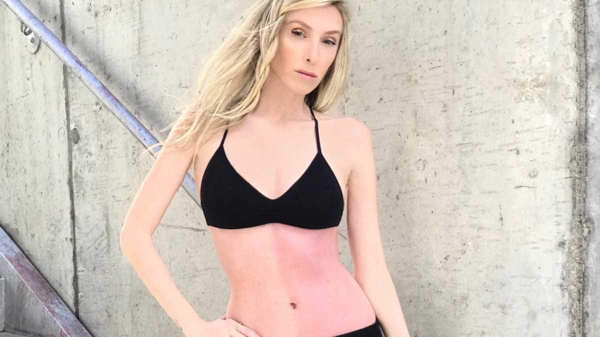 Despite rare genetic condition, California woman becomes model