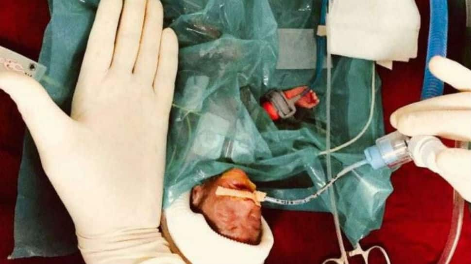 Size of a palm: Weighing 375 grams, India&#039;s smallest baby is born