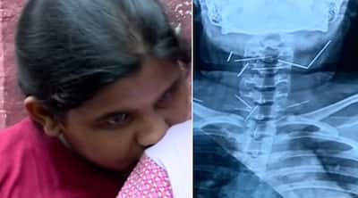 Photo Gallery: Girl complains of throat pain, doctors discover 10 needles stuck