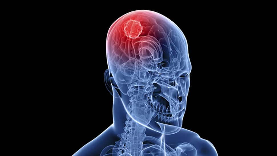 Brain tumors may occur in children with the common genetic syndrome