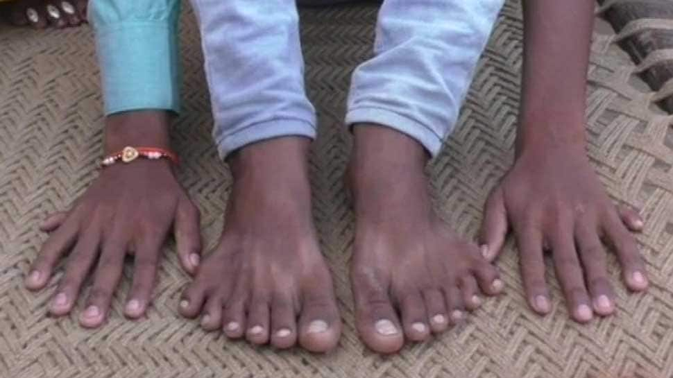 UP boy with 12 fingers, 12 toes faces threat to life, claims family