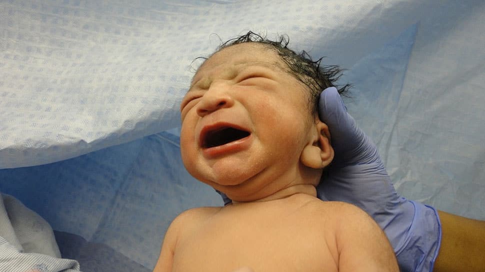 C-section births rise rapidly to more than 20 percent worldwide