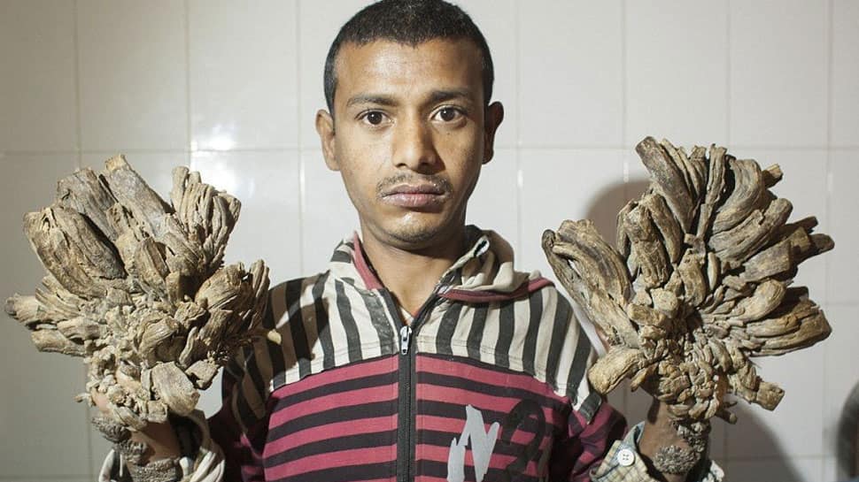 Bangladesh&#039;s &#039;tree man&#039; Abul Bajandar back in hospital for more surgeries