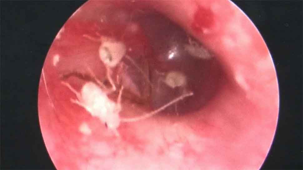 Watch: Doctor finds family of cockroaches living inside man&#039;s ear in China, video goes viral