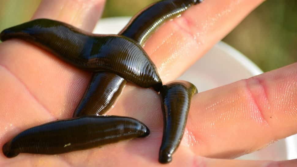 Live leeches removed from China man&#039;s throat after he complained of coughing for two months