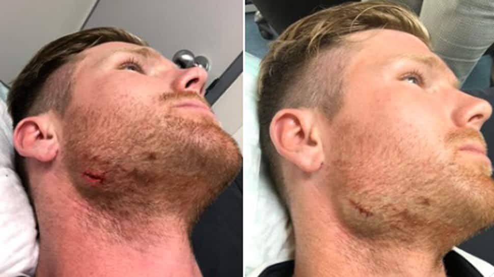 Don&#039;t reverse sweep into your face: Jimmy Neesham&#039;s advice after hurting his chin