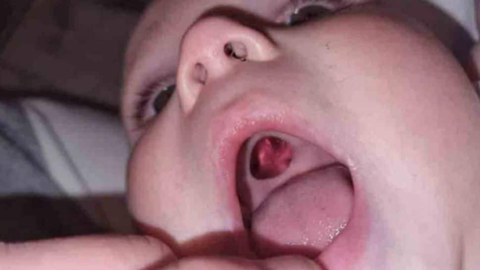 Mom rushes boy with ‘hole’ in mouth to hospital, know what happens next! 