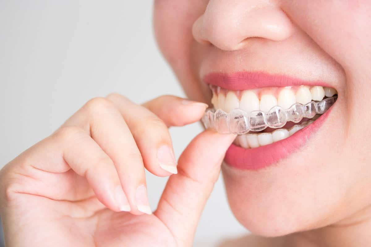 What Is Invisalign Treatment?