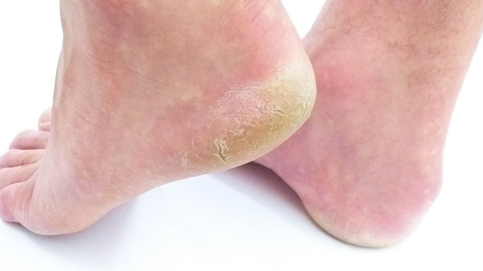 Troubled with dry cracked heels? Check out THESE natural ways to get rid of them