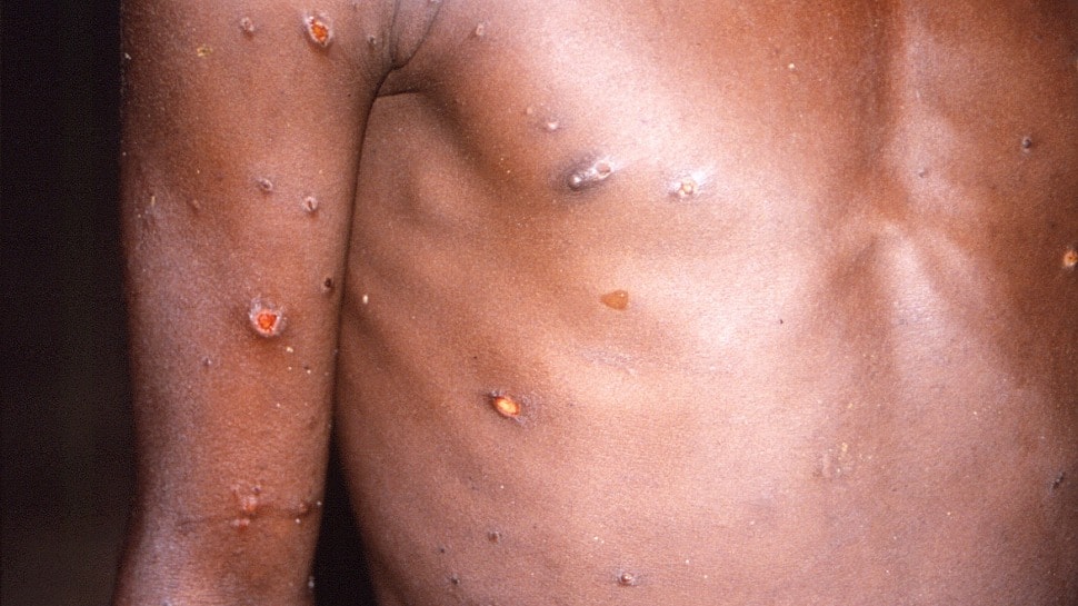 L’épidémie de Monkeypox peut-elle évoluer vers une pandémie comme le Covid-19 ?  Voici ce que les scientifiques ressentent |  Nouvelles du monde