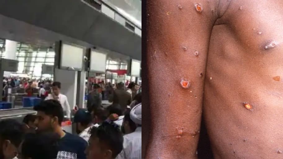 Monkeypox outbreak: India to screen arrival for virus signs, isolate ...